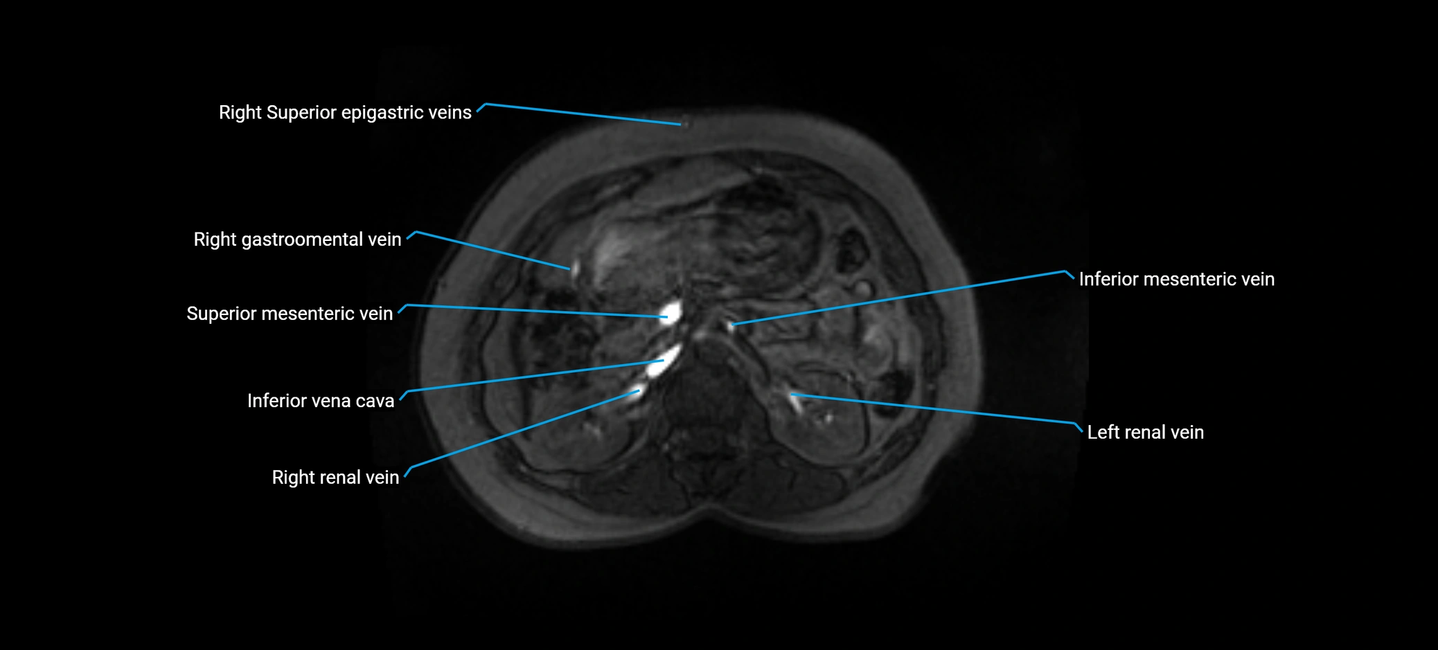 MRV abdomen pelvis & lower limb axial cross sectional anatomy labelled MRI image 65 (1).webp